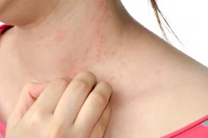 Eczema Skin Large treatment in Lahore Pakistan