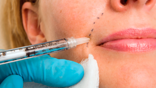 What Is Included in Dermal Fillers to Improve Skin?
