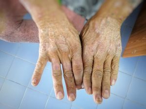 Most Common Auto-Immune Diseases: Skin Lupus and Scleroderma
