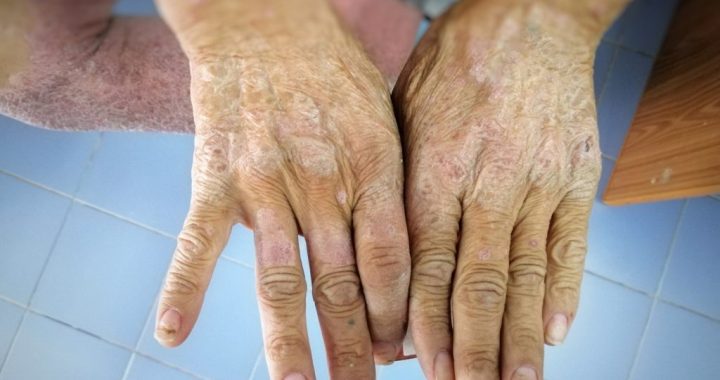 Most Common Auto-Immune Diseases: Skin Lupus and Scleroderma