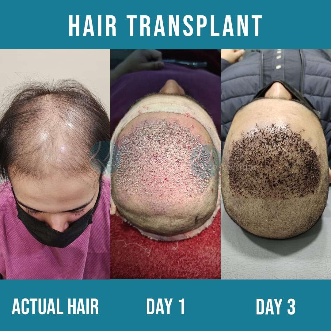 Failure of Best Hair Transplant