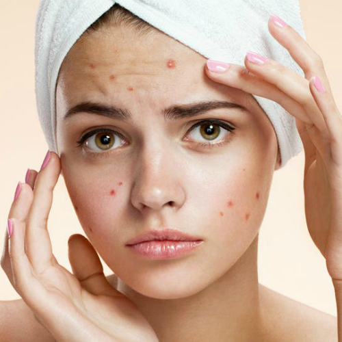 Acne Treatment in Lahore , Acne Treatment in Pakistan