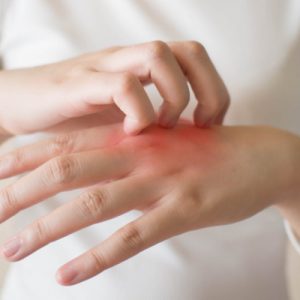 Eczema Treatment in Lahore , Eczema Treatment in Pakistan