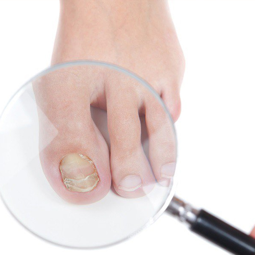 Nail Fungus Treatment in Lahore