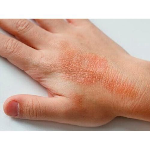 Psoriasis Treatment in Lahore