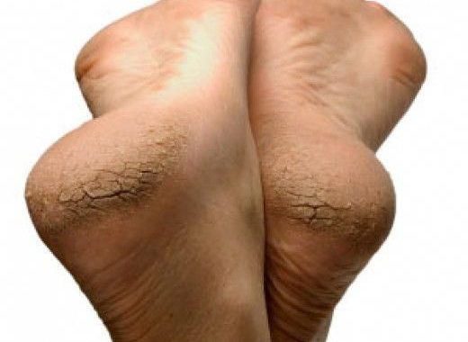 Skin Fissures