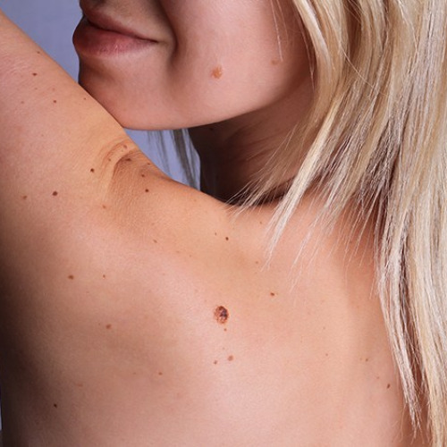 Skin Tags Treatment in Lahore , Skin Tags Treatment in Pakistan