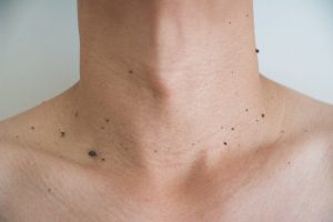 Skin Tags Treatment in Lahore , Skin Tags Treatment in Pakistan