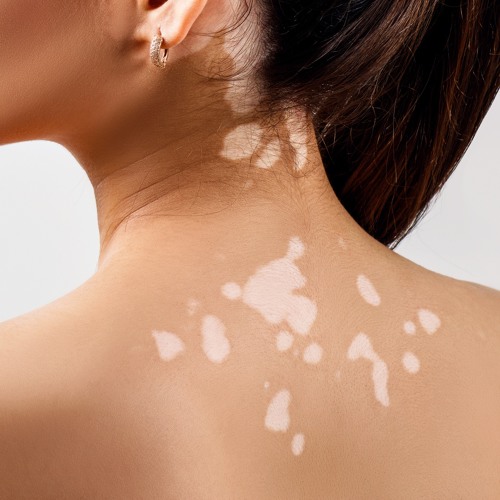 Vitiligo Treatment in Lahore , Vitiligo Treatment in Pakistan