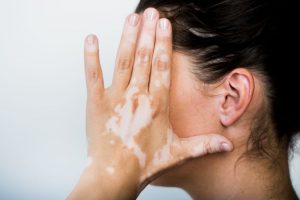 vitiligo treatment cost in pakistan ,vitiligo treatment in islamabad, best vitiligo treatment in pakistan, vitiligo doctor near me