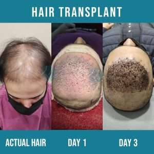 best hair transplant in Lahore