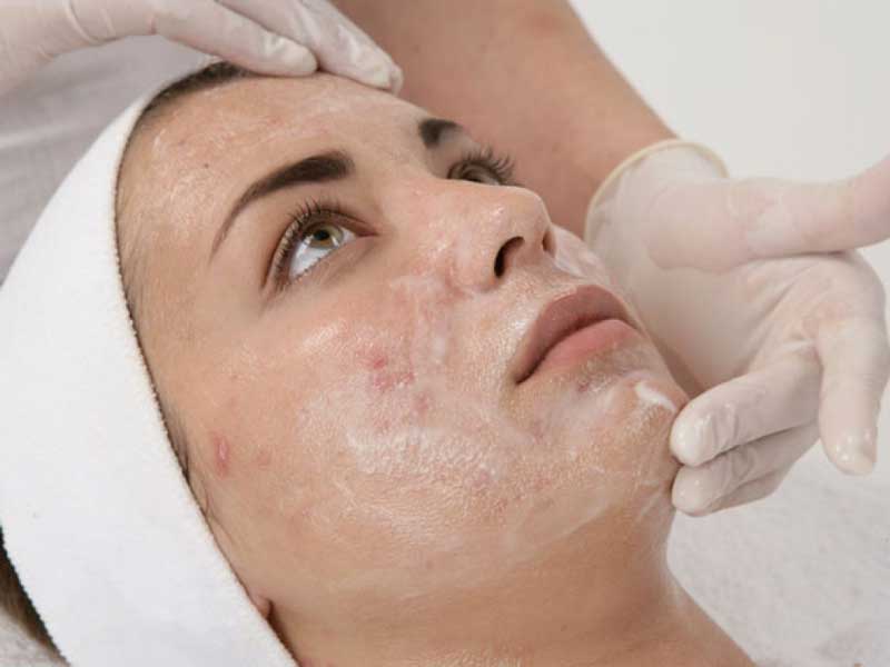 Acne-Chemical-Peel Treatment in Lahore , Acne-Chemical-Peel Treatment in Pakistan