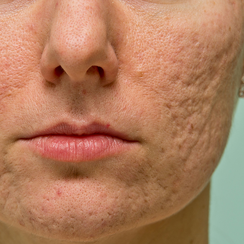 Acne-Scar-Treatment in Lahore , Acne-Scar-Treatment in Pakistan