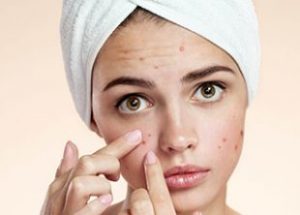 Acne-Treatment in Lahore