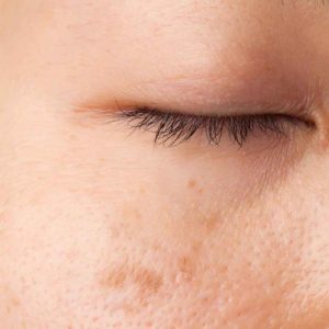 Age Spots Treatment in Lahore , Age Spots Treatment in Pakistan