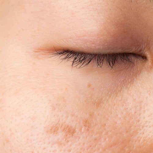 Age Spots Treatment in Lahore , Age Spots Treatment in Pakistan