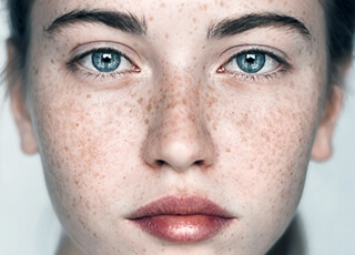 Freckle-Treatment in Lahore, Pakistan