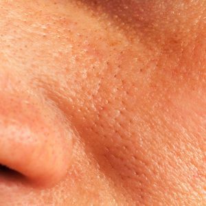 Large Pores Treatment in Lahore , Large Pores Treatment in Pakistan
