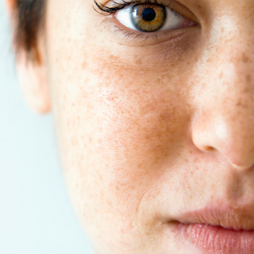 Liver-Spots Treatment in Lahore , Liver-Spots Treatment in Pakistan