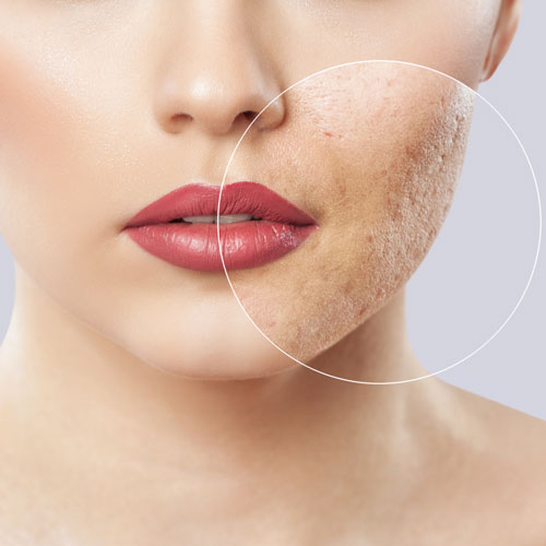 Mild-Scarring Treatment in Lahore , Mild-Scarring Treatment in Pakistan