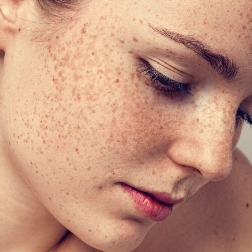 Uneven Pigmentation Treatment in Lahore , Uneven Pigmentation Treatment in Pakistan