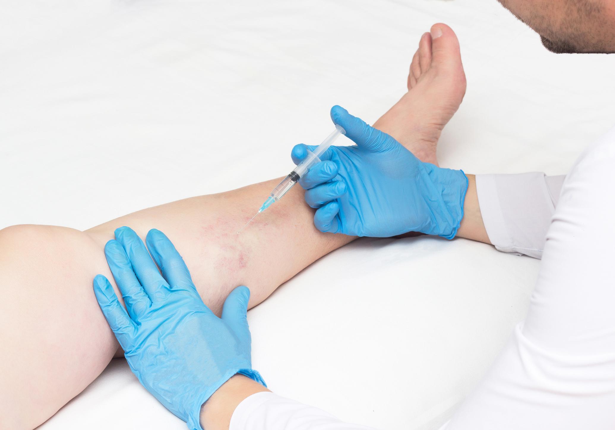 sclerotherapy Treatment in Lahore