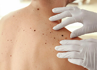 Skin-Tags-Removal Treatment in Lahore , Pakistan