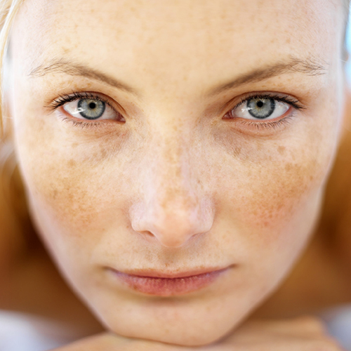 Sun-Spots Treatment in Lahore , Sun-Spots Treatment in Pakistan