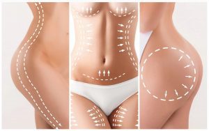 Tumescent Liposuction Treatment in Lahore