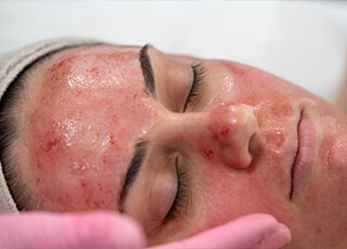 Vampire-Lifting treatment in Lahore , Pakistan