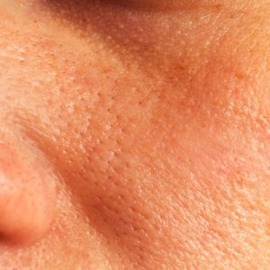 Oily skin and pores Treatment in Lahore , Oily skin and pores Treatment in Pakistan