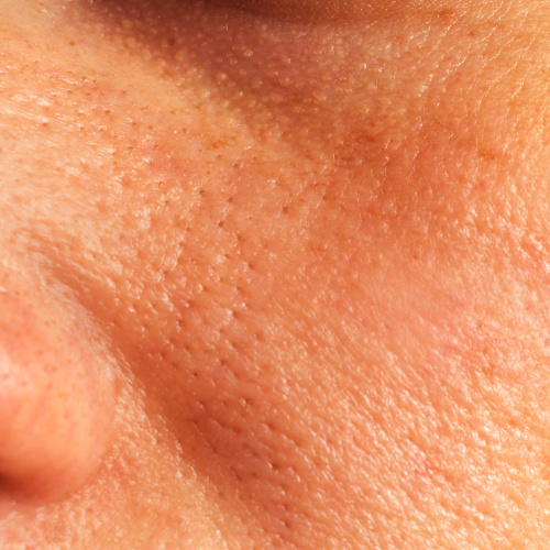 Oily skin and pores Treatment in Lahore , Oily skin and pores Treatment in Pakistan