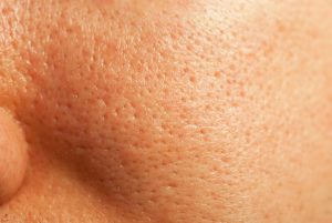 Clogged pores treatment in Lahore , Clogged pores treatment in Pakistan