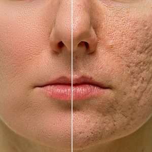 best acne scars removal treatment in lahore, best skin specialist in pakistan, laser treatment in lahore