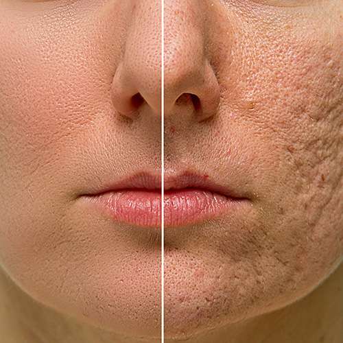 Acne Scars treatment in lahore best acne scars removal treatment in lahore, best skin specialist in pakistan, laser treatment in lahore