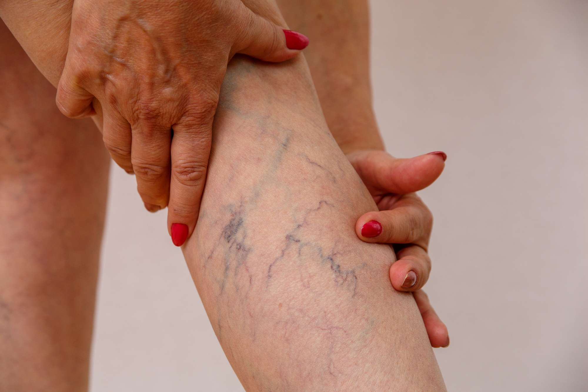 Elderly,Woman,In,White,Panties,Shows,Cellulite,And,Varicose,Veins leg vein Treatment in Lahore, best laser treatment in lahore, Pakistan