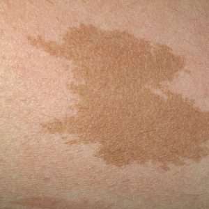 Café-au-lait spots Treatment in Lahore, birthmark treatment in Pakistan