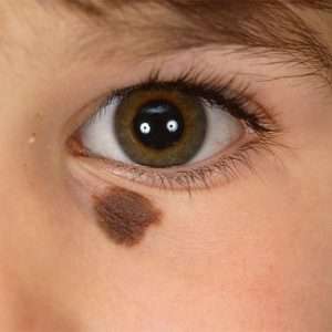 Congenital moles removal treatment in Lahore, birthmark removal treatment in Lahore