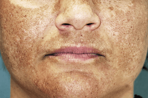 skin treatment in lahore, best melasma treatment in Lahore, best skin clinic in DHA, Dermal melasma treatment in Lahore, best skin specialist in Lahore