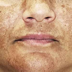 skin treatment in lahore, best melasma treatment in Lahore, best skin clinic in DHA, Dermal melasma treatment in Lahore, best skin specialist in Lahore