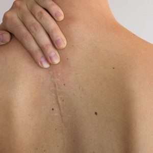 Hypertrophic Scars treatment in lahore, best skin specialist in lahore, laser treatment in lahore