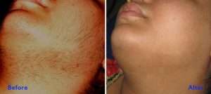 Laser hair removal treatment in lahore, best laser clinic in lahore