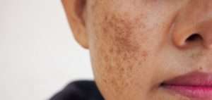 skin treatment in lahore, best melasma treatment in Lahore, best skin clinic in DHA, Melasma treatment in Pakistan, best skin specialist in lahore