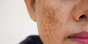 skin treatment in lahore, best melasma treatment in Lahore, best skin clinic in DHA, Dermal melasma treatment in Lahore, best skin specialist in Lahore