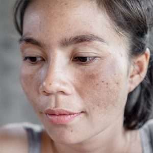 skin treatment in Lahore, best melasma treatment in Lahore, best skin clinic in DHA, Mixed Melasma treatment in Lahore, best skin specialist in Lahore