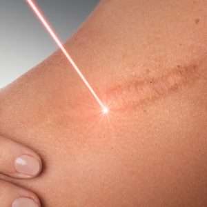 Scar Prevention treatment in lahore, best skin treatment in lahore, laser treatment in lahore