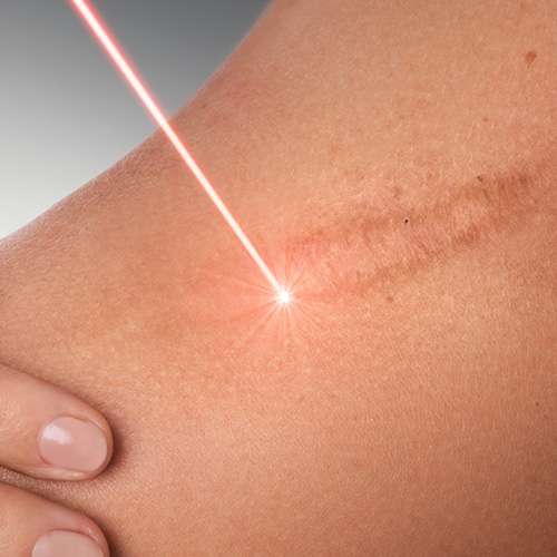 Scar Prevention treatment in lahore Scar Prevention treatment in lahore, best skin treatment in lahore, laser treatment in lahore
