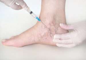 aser treatment for varicose veins in Lahore, aser treatment for leg veins, best skin specialist, best dermatologist in pakistan, leg veins injection treatmnet