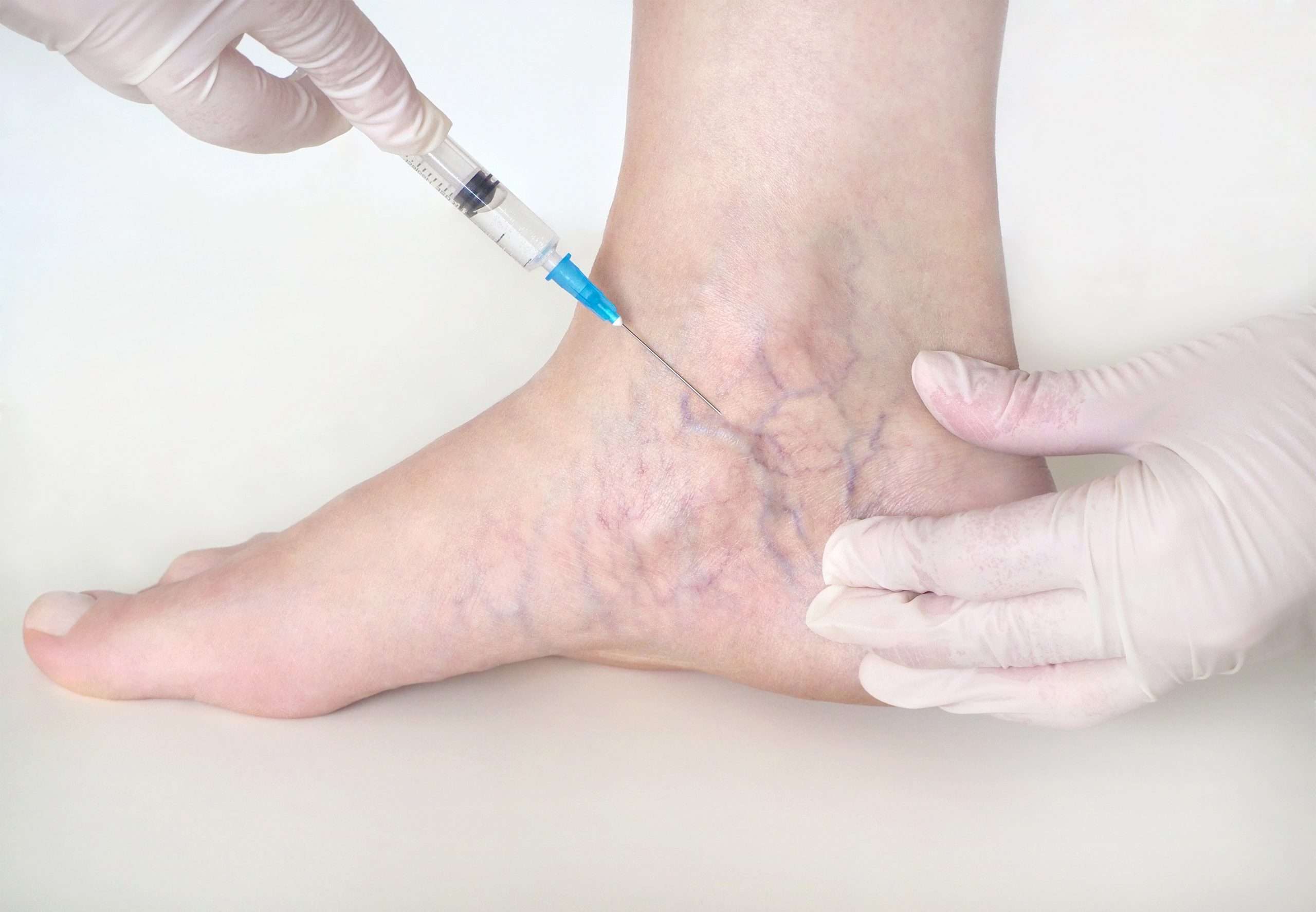 Sclerotherapy aser treatment for varicose veins in Lahore, aser treatment for leg veins, best skin specialist, best dermatologist in pakistan, leg veins injection treatmnet