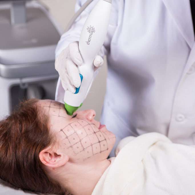 THERMAGE® treatment in Lahore, skin tightening treatment in pakistan, pulsed dye laser treatment in Lahore